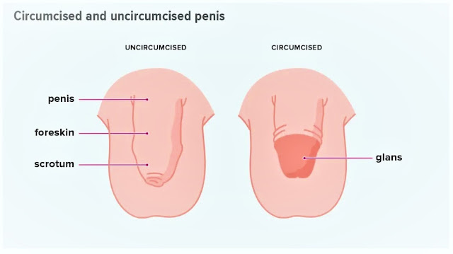 Circumcision might have various health benefits