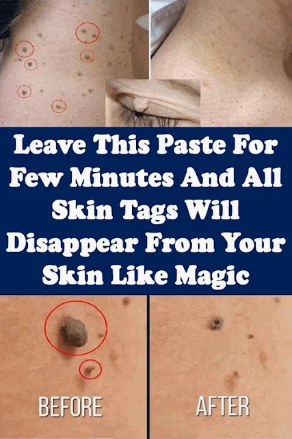 Leave This Paste For Few Minutes And All Skin Tags Will Disappear From Your Skin Like Magic 