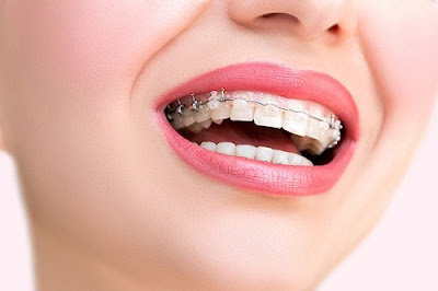 Niềng răng hô hàm trên có hiệu quả hay không?