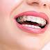 Phương pháp niềng răng hô hàm trên