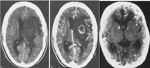 abnormal mri brain