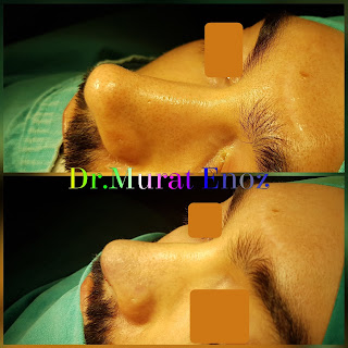 2nd Revision Rhinoplasty Operation in Men, Second Revision Nose Aesthetic Surgery For Male,Revision Rhinoplasty Istanbul,