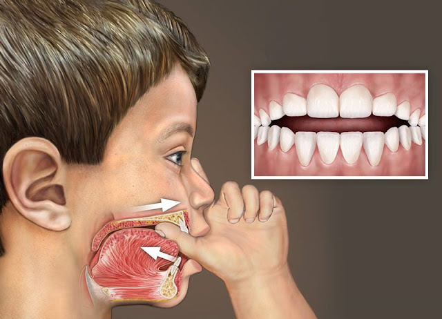 Open Bite: Diagnosis and Treatment