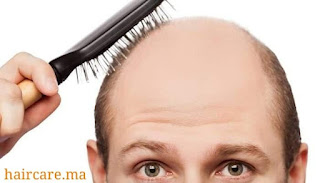 علاج-تساقط-الشعر-دليل-شامل