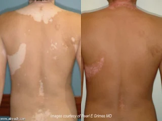 what is vitiligo