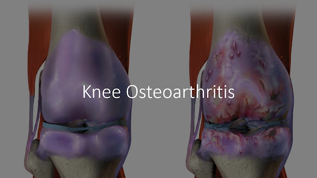 knee osteoarthritis