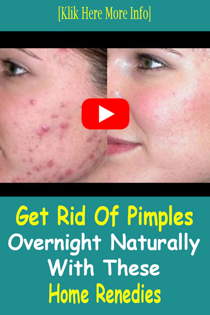How To Get Rid Of Pimples Overnight At Home