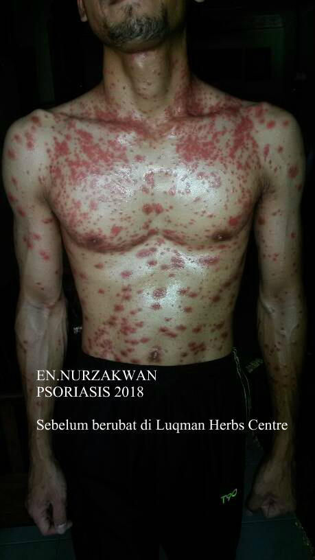 Nurzakwan dan Psoriasis (Jangan Baca kalau lemah semangat)