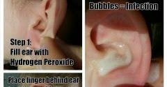 Don T Pin That Hydrogen Peroxide To Diagnose And Cure Ear Infections