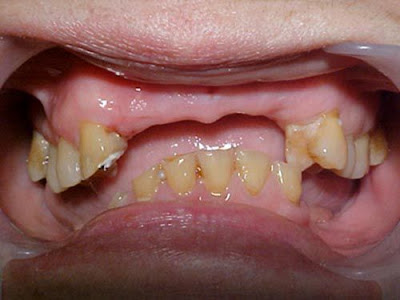 Mất nhiều răng có nên làm cầu răng hay không ?