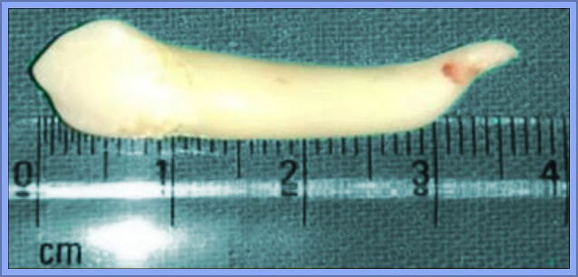 Dr Srivastava Pulled This Record Breaking Tooth For Indian Pride