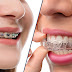 Tại sao chỉnh nha khi răng bị khấp khểnh?