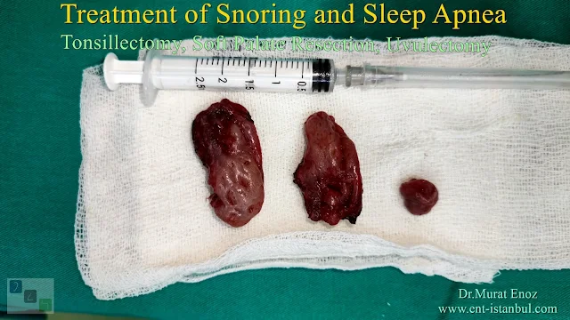 Tonsillectomy, Soft Palate Resection, Uvulectomy, Treatment of Snoring and Sleep Apnea