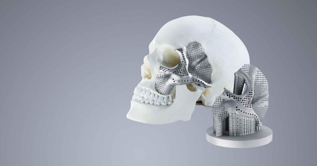 Craniomaxillofacial Implants Market Size, Share, Outlook, and Opportunity Analysis, 2019 - 2027