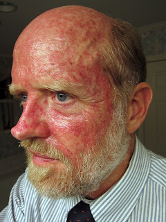 Left side of face one day after stopping Efudex