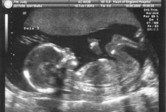 17-Weeks-Pregnant-Ultrasound