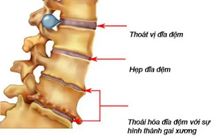 Nguyên nhân thoái hóa cột sống thắt lưng 