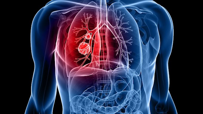 Lung Cancer Complete Information