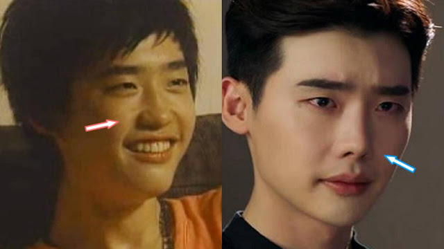 perubahan bentuk hidung Fakta Lee Jong Suk Lee Jong Suk Melakukan Oplas