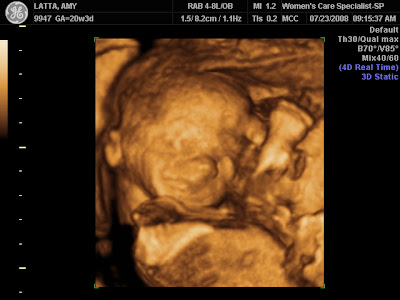 3d ultrasound photos. 3d ultrasound pictures at 26