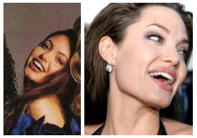 Angelina Jolie Plastic Surgery Before And After
