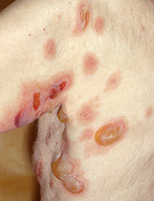 Pemphigus vulgaris