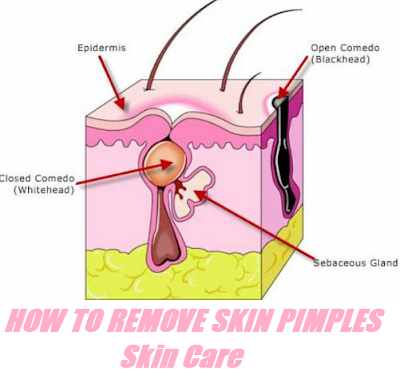 HOW-TO-REMOVE-SKIN-PIMPLES-Skin-Care 