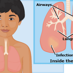 Health Challenge:Pneumonia