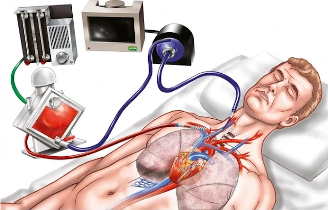 ECMO là gì, khi nào bệnh nhân cần phải can thiệp tim phổi nhân tạo