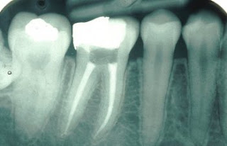 Root Canal