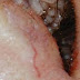 Hope you can still eat after seeing this image of maggots in this woman’s eye