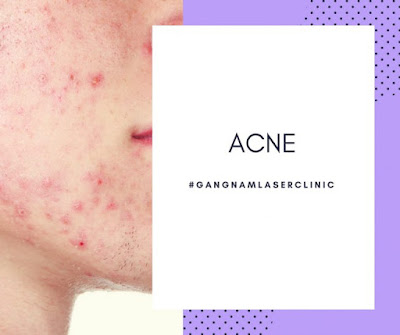 laser for acne scars