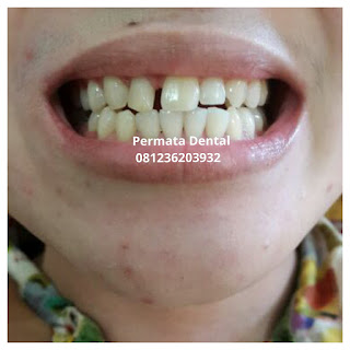 gambar foto contoh sebelum dan sesudah veneer gigi kelinci buatan manis cantik bali jember banyuwangi murah berkualitas di PERMATA DENTAL gambar gigi rusak yang di veneer gigi yang tidak rapi gigi renggang gigi patah cuil rompal pendek karies hitam kuning