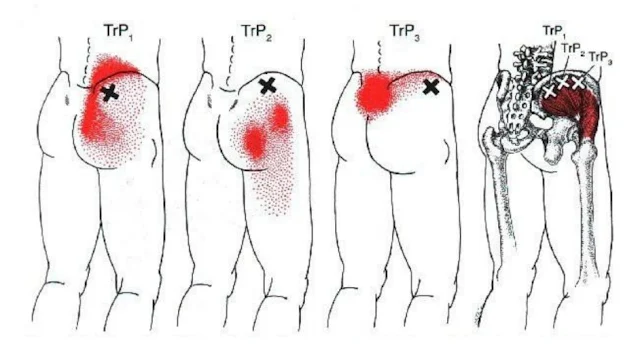 lumbalgia y ciática - cuadrado lumbar - gluteo medio - mc spa