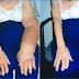 Natural Lymphedema Treatment