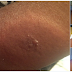 Graphic Photos; See What Garlic Did To The Hand Of This Pretty Girl (Viewers Discretion)