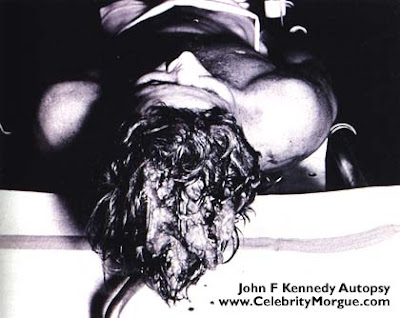 kennedy autopsy photographs. images JFK autopsy photograph.