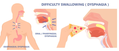 Oropharyngeal Cancer