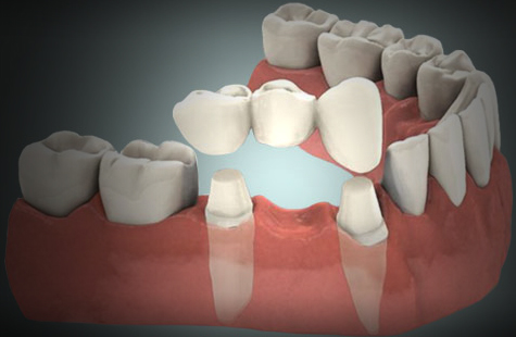 Diferencias entre carillas y coronas dentales