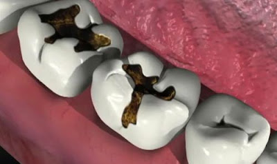 Ngăn ngừa bệnh sâu răng như thế nào?