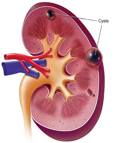 Rawatan Herba Dan Pemakanan: Rawatan Kidney Cyst (Cyst 