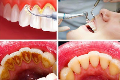 Inilah Cara Mudah  dan Alami Merontokkan Karang pada Gigi