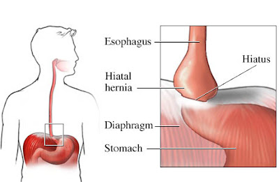 What is Paraesophageal hernia - Definition, Symptoms, Causes, Treatment