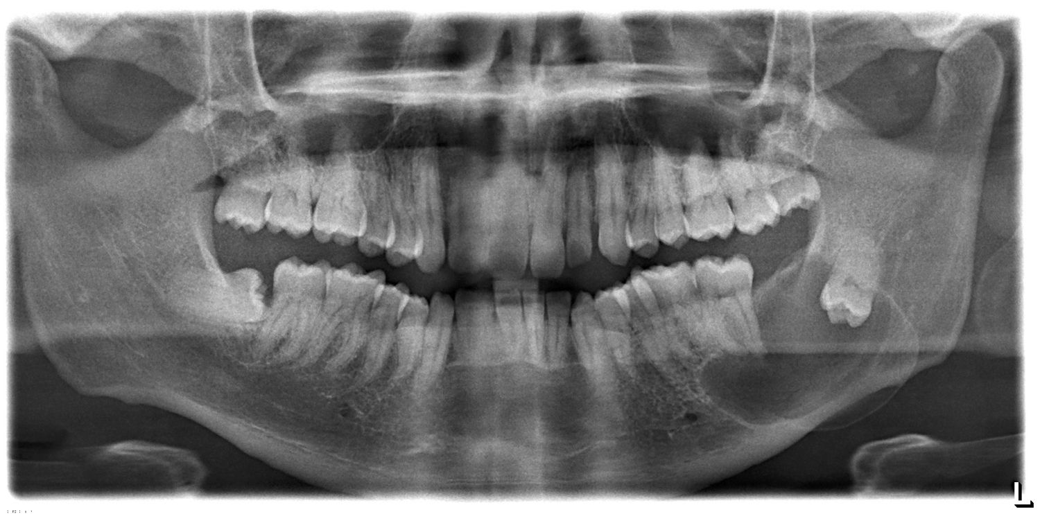 Dentigerous cyst left mandible