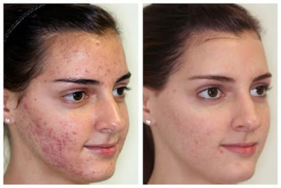 After and Before Microdermabrasion Acne Scars