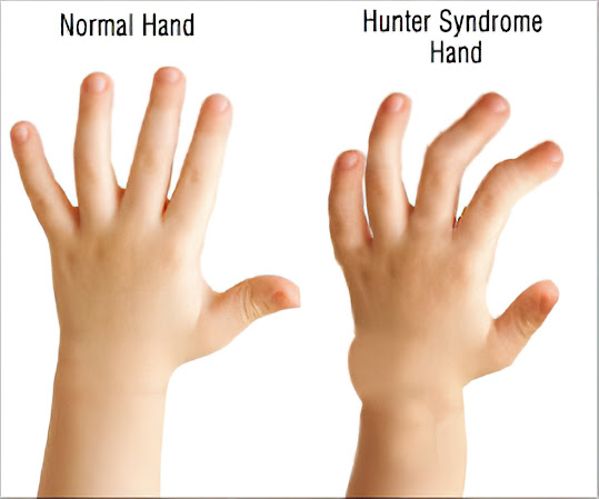 Hunter Syndrome Treatment