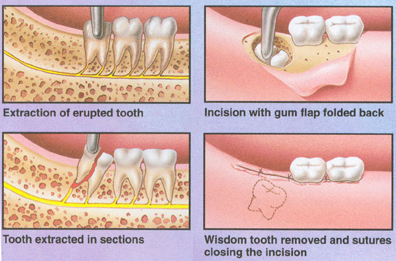 teeth diagram with labels. After the tooth is removed,