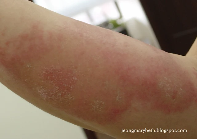 알레르기접촉피부염의 아급성기 피부 병변 이미지