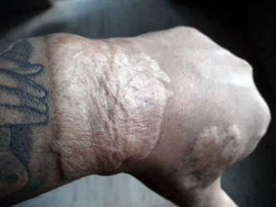 Laser Tattoo RemovalResults