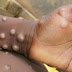 Varíola dos macacos: entenda a transmissão, os sintomas e a vacina